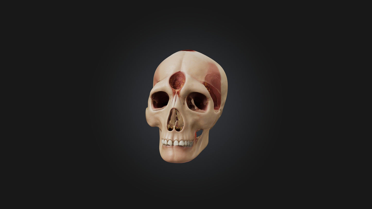 3D model Infected Sinus VR / AR / low-poly